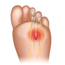 morton's neuroma